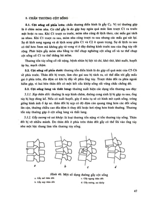 5. CHẤN THƯƠNG CỘT SỐNG
5.1. Cột sững cố phía trên: chấn thương điên hình là gẫy c2. Vị trí thường gập
là ỏ chân mỏm nha. Co chế gẫy là do gập hay ngửa quá mức làm trượt Cl ra truóc
mặt hoặc ra sau. Khi Cl trượt ra truóc, mỏm nha cũng đi lệch theo, các mấu gai tách
xa nhau. Khi Cl trượt ra sau, mỏm nha cũng trượt ra sau nhung các mấu gai sát lại.
Sụ di lệch sang ngang và di lệch xoay giũa Cl và C2 ít quan trọng. Sụ di lệch ra sau
có thể hon 5mm mà không gây tử vong vì ỏ dây đường kính truốc sau của óng tủy rất
rộng. Phát hiện gẫy mỏm nha bằng tu thế chụp nghiêng cột sống cổ và tu thế chụp
cột sống cổ Cl tu thế thẳng há mồm.
Thương tổn tủy sóng cổ rất nặng, bệnh nhân bị liệt tứ chi, khó thỏ, khó nuốt, huyết
áp hạ, mạch chậm.
5.2. Cột sống cổ phía dưới: thương tổn điển hình là do gập cổ quá múc cùa C5-C6
về phía trước. Thân đốt bị trượt, làm cho gai sau bị tách ra, có thè dẫn tới gẫy mấu
gai ỏ phía trên, đĩa đệm có khi bị đẩy vê phíaống tủy. Trượt thân đốt ra phía ngoài
hiếm gặp, vì hai bên thân đốt có một kết cấu khóp sóng rất vũng chắc chống đỡ.
5.3. Cột sống lưng và thát lưng: thuồng xuất hiện các dạng tổn thương sau đây:
5.3.1. Xẹp thân đổi: thuồng là xẹp hình chêm, đường cong sinh lý bị gập ra sau, ống
tủy bị hẹp đáng kể. Nếu có xuất huyết, gâyổ máu tụ sẽ có hình mò cạnh sổng, trông
giống hình ảnhổ áp xe. thân đốt bị xẹp có độ đậm cản quang tăng hon các đốt sống
lân cận, thuồng chiều cao dĩa đệm ít thay đồi hoặc húi rộng hon bình thường. Thương
tổn này thường gặp ỏ cột sổng lung và thắt lung.
5.3.2. Gầy xương và sai khớp: là loại thương tồn năng vì tổn thương tùy sóng. Thân
đốt bị vồ nhiều mảnh. Do thân đốt ỏ phía trên thản đốt gẫy có thể lồi vàoống tùy
nhu một bậc thang làm tổn thương tủy sống.
Hình 46. Một số dạng đường gẫy cột sóng
a. Gẫy mè thân đốt c. Gãy ngang thân đốt
b. Gẫy xẹp thân đối d. Gãy xương, sai khớp
47
 