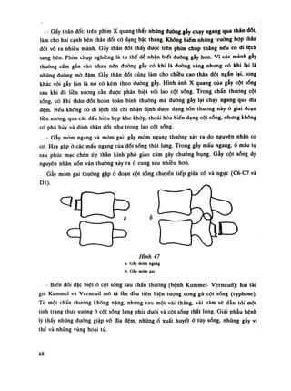 . - Gấỵ thân đốt: trên phim X quang thấy những đuòng gẫy chạy ngang qua thân dổi,
làm cho hai cạnh bên thân đốt có dạng bậc thang. Khống hiếm những truồng họp thân
đốt vỗ ra nhiều mảnh. Gây thân đốt thấy được trên phim chụp thẳng nếu có đi lệch
sang bên. Phim chụp nghiêng là tu thế dễ nhận biết đuòng gẫy hon. Vì các mảnh gẫy
thuồng cắm gắn vào nhau nên đường gẫy có khi là đuòng sáng nhung có khi lại là
những đuòng mò đậm. Gẫy thân dốt cũng làm cho chiều cao thân đốt ngắn lại, song
khác vói gẫy lún lả nó có kèm theo đường gẫy. Hình ảnh X quang của gẫy cột sóng
sau khi đã liền xương càn đuọc phân biệt vói lao cột sóng. Trong chấn thương cột
sống, có khi thân đốt hoàn toàn bình thuồng mà duòng gẫy lại chạy ngang qua dĩa
đệm. Nếu không có di lệch thì chi nhận định được dạng tổn thương này ỏ giai đoạn
liền xương, qua các dấu hiệu hẹp khe khớp, thoái hóa biến dạng cột sống, nhưng không
có phá hủy và dính thân đốt nhu trong lao cột sóng.
- Gẫy mỏm ngang và mỏm gai: gẫy mỏm ngang thường xảy ra do nguyên nhân co
co. Hay gặp ỏ các mấu ngang của đốt sóng thắt lung. Trong gẫy mấu ngang,ổ máu tụ
sau phúc mạc chèn ép thần kinh phó giao cảm gây chuông bụng. Gây cột sống dọ
nguyên nhân uốn ván thường xảy ra ỏ cung sau nhiều hon.
Gẫy mỏm gai thường gặp ỏ đoạn cột sóng chuyên tiếp giữa cổ và ngực (C6-C7 và
Hình 47
a. Gẫy mỏm ngang
b. Gãy mỏm gai
- Biến đổi đặc biệt ỏ cột sống sau chấn thuong (bệnh Kummel- Verneuil): hai tác
già Kummel và Verneuil mô tả lần đàu tiên hiện tuông cong gù cột sống (cyphose).
Tù một chấn thương không nặng, nhung sau một vài tháng, vài năm sẽ dẫn tỏi một
tình trạng thưa xương ỏ cột sống lung phía đuôi và cột sống thắt lung. Giải phẫu bệnh
lý thấy nhũng đường giập võ dĩa đệm, nhũngổ xuất huyết ỏ tùy sống, nhũng gẫy vi
thế và nhũng vùng hoại tử.
48
 