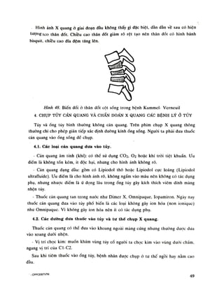 Hình ảnh X quang ỏ giai đoạn đầu không thấy gì dặc biệt, dần dần vê sau có hiện
tượng leo thân dốt. Chiều cao thân đốt giảm rõ rệt tạo nên thân dốt có hình bánh
bisquit, chiều cao dĩa đệm tăng lên.
Hình 48. Biến dổi ỏ thân đốt cột sổng trong bệnh Kummel- Verneuil
4. CHỤP TỦY CẨN QUANG VÀ CHẨN DOẤN X QUANG CẤC BỆNH LÝở TỦY
Tùy vàống tùy bình thường không cản quang. Trên phim chụp X quang thông
thường chi cho phép gián tiếp xác định đường kínhống sống. Nguôi ta phải dua thuốc
cản quang vàoống sống dế chụp.
4.1. Các loại cản quang dưa vào tủy.
- Càn quang âm tính (khí): có thế sử dụng CƠ2, O2 hoặc khí tròi tiệt khuẩn. Ưu
điềm là không tốn kém, Ít dộc hại, nhưng cho hình ảnh không rõ.
• Cán quang dạng dầu: gôm có Lỉpiodo! thô hoặc Lipiodol cực loãng (Lipiodol
ultraAuide). Ưu điếm là cho hình ảnh rõ, không ngấm vào máu nên không có tác dụng
phụ, nhưng nhược điềm là ứ đọng lâu trongống tủy gây kích thích viêm dính màng
nhện tủy.
- Thuốc càn quang tan trong nuóc nhu Dimer X, Omnipaque, Iopamiron. Ngày nay
thuốc cản quang dua vào tủy phổ biến là các loại không gây ion hóa (non ioniquc)
như Omnipaquc. Vì không gãy lon hóa nên ít có tác dụng phụ.
4.2. Các dường dưa thuốc vào tủy và tư thế chụp X quang.
Thuốc càn quang có thề đua vào khoang ngoài màng cứng nhung thuòng dược dưa
vào xoang dưới ohện.
- Vị trí chọc kim: muốn khám vùng tủy cổ nguôi ta chọc kim vào vùng dưới chầm,
ngang vị trí của C1-C2.
Sau khi tiêm thuốc vàoống tùy, bệnh nhân được chụp ỏ tư thế ngồi hay nằm cao
đầu.
- CPPCOBTVTK 49
 