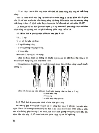 - Vị trí chọc kim ỏ thắt lung được chi định đè khám vùng tủy lung và thất lưng
cùng.
Sau khi tiêm thuốc vàoống tủy bệnh nhân được chụp à tu thế nằm dốc vè phía
đàu 20-30° nếu muốn tìm tổn thương vùng túy lung. Nếu muốn tìm tốn thương vùng
thắt lung và bao rễ, bệnh nhân được chụp ỏ tu thế nằm dóc về phía chân 10-15°.
Để đánh giá đày đủ một qua trình bệnh lý ỏ tủy nhất thiết phải chụp tủy ỏ hai bình
diện thẳng và nghiêng, đôi khi phải bổ sung phim chụp chếch 3/4.
4.3. Hỉnh ảnh X quang một số bệnh hay gặp ỏ tủy.
4.3.1. u tủy:
u tủy có thể gặp các loại:
- u ngoài màng cứng.
- u trong màng cứng ngoài tủy.
- u trong tủy.
Hình ảnh X quang có các dạng:
- Chèn tắc hoàn toàn lưu thông cột thuốc cản quang. Bò cột thuốc tại vùng u có
hình khuyết dạng càng cua hoặc trôn chén.
- Hình gián đoạn lưu thông cột thuốc trên một đoạn dài, giói hạn vùng khuyết thuốc
không rõ.
a i> c
Hình 49. So dồ sụ biến đổi cột thuốc cản quang của các loại u ỏ tủy
a. u ngoài màng cứng
b. u trong tùy
c. u trong màng cúng, ngoài tùy
4.3.2. Hình ảnh X quang cùa thoát vị dĩa đệm (TVĐĐ):
TVĐĐ hay gặp ỏ vùng cột sống cồ và cột sống thắt lung. ít khi xây ra ỏ cột sóng
ngục. Đa số các truồng họp thoát vị dĩa đệm là do sụ di chuyến cùa nhân nháy ra phía
sau nên thuồng gây chèn ép ỏ bò trước, cột thuốc cản quang tương úng vị trí khe dĩa
đệm, dấu hiệu này rất dễ nhận biết trên phim chụp tủy tu thế nghiêng.
50
 