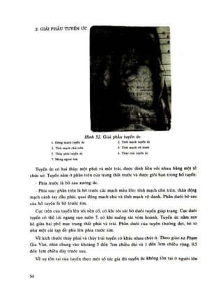 2. GIẢI PHẪU TUYẾN ức
Hình 52. Giải phẫu tuyến ức
ì. Dộng mạch tuyến úc 2. Tĩnh mạch tuyến ức
3. Tĩnh mạch chủ trên 4. Tĩnh mạch vồ danh
5. Thúy phải luyến ức 6. Thúy trái luyến úc
7. Màng ngoài tim.
Tuyến ức có hai thúy: một phải và một trái, được dính liền vói nhau băng một tổ
chức xo. Tuyến nằm ò phàn trên của trung thất truóc và được giói hạn trong hò tuyến:
- Phía trước là bò sau xuong ức.
- Phía sau: phàn trên là bò trước các mạch máu lốn: tĩnh mạch chủ trên, thân động
mạch cánh tay dầu phải, quai động mạch chù và tĩnh mạch vó danh. Phàn đuối bò sau
của hố tuyến là bò trước tim.
Cục trên cùa tuyến lên tói nền cổ, có khi tói sát bò dưới tuyến giáp trạng. Cục đuối
tuyến có thế tói ngang sụn suôn 7, có khi xuống sát vòm hoành. Tuyến ức nằm xen
kẽ giữa hai phế mạc trung thất phải và trái. Phàn dưới của tuyến thường dẹt, bè to
nhu một cái tạp dề phù lên phía trước tim.
Vê kích thuốc thúy phải và thúy trái tuyến có khác nhau chút ít. Theo giáo sư Phạm
Gia Vãn, nhìn chung vào khoảng 5 đến 7cm chiều dài và Ì đến 3cm chiều rộng, 0,5
đến lem chiều dày trước sau.
Về sụ tồn tại của tuyến theo một số tác giả thì tuyến ức không tồn tại ỏ nguôi lỏn
54
 