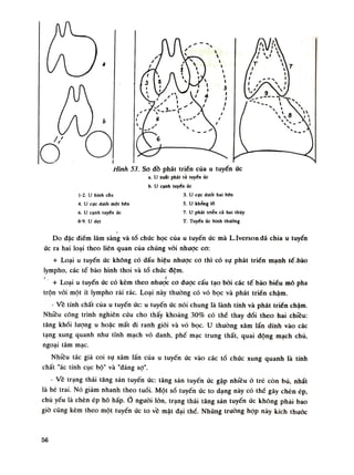 Hình 53. So đồ phát triển của u tuyến ức
a. u xuất phát từ luyến úc
b. u cạnh tuyến úc
1-2. u hình cáu 3. u cực dưới hai ben
4. u cực dưói một bên 5. u khàng lã
6. u cạnh tuyếnửc 7. u phát triền cả hai thúy
8-9. u dẹt T. Tuyến úc binh Ihưòng
Do đặc điểm lâm sàng và tổ chúc học của u tuyến ức mà L.Iversonđã chia u tuyến
úc ra hai loại theo liên quan của chúng vói nhược CO:
+ Loại u tuyến ức không có dấu hiệu nhược cơ thì có sụ phát triển mạnh tế-bào
lympho, các tế bào hình thoi và tổ chức đệm.
+ Loại u tuyến ức có kèm theo nhược co được cấu tạo bói các tế bào biếu mô pha
trộn vói một ít lympho rải rác. Loại này thuồng có vò bọc và phát triển chậm.
- Về tính chất của u tuyến úc: u tuyến úc nói chung là lành tính và phát triến chậm.
Nhiều công trình nghiên cứu cho thấy khoảng 30% có thể thay dồi theo hai chiêu:
tăng khói lượng u hoặc mất đi ranh giói và vỏ bọc. u thường xâm lấn dính vào các
tạng xung quanh nhu tĩnh mạch vô danh, phế mạc trung thất, quai động mạch chủ,
ngoại tâm mạc.
Nhiều tác giả coi sụ xâm lấn cùa u tuyến ức vào các tổ chúc xung quanh là tính
chất "ác tính cục bộ" và "đáng sọ".
- Vê trạng thái tăng sản tuyến ức: tăng sản tuyến úc gặp nhiều ỏ trẻ còn bú, nhất
là bé trai. Nó giám nhanh theo tuồi. Một số tuyến úc to dạng này có thế gây chèn ép
chủ yếu là chèn ép hô hấp.Ỏ nguôi lòn, trạng thái tăng sản tuyến úc không phải bao
giò cũng kèm theo một tuyến ức to vê mặt đại thế. Nhũng trường họp này kích thuốc
56
 