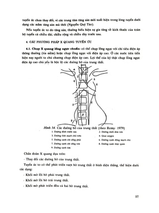 tuyến úc chua thay đổi, vì các trung tâm tăng sản mói xuất hiện trong lòng tuyến đuối
dạng các mầm tăng sản mà thôi (Nguyễn Quý Tảo).
Nếu tuyến úc to do tăng sản, thuồng biểu hiện sụ gia tăng về kích thuóc cùa toàn
bộ tuyến cả chiều dài, chiều rộng và chiều dày trước sau.
4. CẤC PHƯƠNG PHẤP X QUANG TUYẾN ức
4.1. Chụp X quang lổng ngực chuẩn: có thể chụp lồng ngục vối chi tiêu điện áp
thông thường (tia mềm) hoặc chụp lồng ngục vói diện áp cao. các nước tiên tiến
hiện nay nguôi ta chủ chuông chụp điện áp cao. Lọi thế của kỹ thật chụp lồng ngục
diện áp cao chù yếu là bộc lộ các đường bò của trung thất.
Hình 54. Các đường bò của trung thất (theo Remy- 1979)
1. Dường đình trước sau 2. Dường dưới đòn trái
3. Dường tĩnh mạch chù trên 4. Quai azygos
5. Dường cạnh cột sống phải 6. Dưỡng cạnh dộng mạch chú
7. Buông cạnh cột sòng trái 8. Dường cạnh Ihực quàn
9. Dưỡng cạnh tim.
Chẩn đoán X quang dựa trên:
- Thay đối các đuòng bò của trung thất.
Tuyến ức to có thè phát triển vượt bò trung thất ỏ bình diện thẳng, thề hiện duỗi
các dạng:
- Khối mò rỏi bò phải trung thất.
- Khối mò lồi bò trái trung thất.
- Khối mò phát triển đều cả hai bò trung thất.
57
 