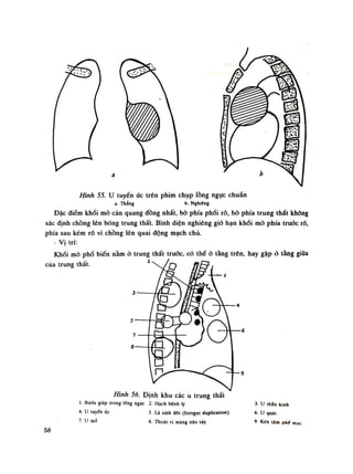 Hình 55. u tuyến ức trên phim chụp lồng ngục chuẩn
a. Thẳng b. Nghiêng.
Đặc điểm khối mò cản quang đồng nhất, bò phía phổi rõ, bò phía trung thất không
xác định chồng lên bóng trung thất. Bình diện nghiêng gió hạn khối mò phía trước rỗ,
phía sau kém rỗ vì chồng lên quai dộng mạch chủ.
- Vị trí:
Khói mò phổ biến nằm ỏ trung thất trưốc, có thể ỏ tàng trên, hay gặp ò tàng giữa
của trung thất. z
Hình 56. Định khu các u trung thất
1. Bướu giáp irong lổng ngực 2. Hạch bệnh lý
4. u tuyến úc 5. Lá sinh đối (íoregut duplication)
7 u
mỡ 8. Thoát vị màng nào tùy
3. u thán kinh
6. u quái
9. Kén Um phí mác
58
 