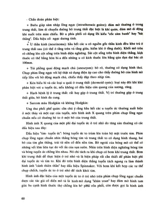 - Chẩn đoán phân biệt:
+ Buóu giáp xâm nhập lồng ngực (intrathoracic goitre): đám mò thuồng ỏ trong
trung thất, làm di chuyển (tuông bò trung thất đặc biệt là khí quản, dám mò di dộng
khi nuốt trên màn chiếu. Bò u phía phổi có dạng lồi kiểu "cóc sảm banh* hay "bát
thẳng". Dấu hiệu cổ- ngục dương tính.
+ u thần kinh (neurinoma): hầu hết các u có nguồn góc thần kinh đều khu trú ỏ
trung thất sau (có thể ỏ tầng trên và tầng giữa, hiếm khi ỏ tầng đuối). Khói mò tròn
rõ chồng lên cột sống trên bình diện nghiêng. Sát cột sống trên bình diện thẳng, kíọh
thuốc có thế bằng hòn bi a đến những u có kích thuốc lốn bằng qua đạn đại bác cô
lOOmm.
+ Túi phồng quai động mạch chú (aneurysm): bò rõ, thuồng có dạng hình thoi.
Chụp phim lồng ngực vối kỹ thật sử dụng điện áp cao cho thấy đường bò của hình mò
tiếp liền vói bò động mạch chù, chiếu thấy đập theo nhịp tim.
+ Kén biếu bì và các loại u quái ỏ trung thất (dermoid cysts): loại này đôi khi khó
phân biệt voi u tuyến ức, nếu không có dấu hiệu cán quang của xương, răng.
+ Hạch bệnh lý ỏ trung thất: rất hay gặp ỏ trung thất. Vị trí thường gặp ỏ trung
thất giữa, bò hình đa cung.
+ Sarcom máu Hodgkin và không Hodgkin:
Ung thu phổi phế quản: cần chú ý rằng hầu hết các u tuyến ức thường xuất hiện
ỏ một thúy và một cục của tuyến, nên hình ảnh X quang trên phim chụp lồng ngục
chuẩn nếu có thuồng bè to ó một bò của trung thất.
Hình ảnh X quang của một phì đại tuyến ức ỏ trẻ nhỏ do tăng sản thường có các
dấu hiệu sau đây:
Dấu hiệu "tim- tuyến ức": bóng tuyến úc to trùm lên toàn bộ mặt trước lim. Phim
chụp lồng ngục chuẩn nhìn thẳng bóng tim và trung thất to có dạng hình thang, hai
bò của tim gần thẳng, trải từ nền cổ đến nền tim. Bò ngoài của bóng mò có thế có
nhũng vết lõm liên tục do vết ấn của sụn suôn. Nhìn trên bình diện nghiêng bóng tim
và bóng tuyến ức chồng lẽn nhau. Nó chi tách ra khi chụp có bom khí trung thất. Bom
khí trung thất dễ thực hiện ỏ trẻ nhỏ và là biện pháp rất càn thiết đế phân biệt phì
đại tuyến ức và tim to. Khi đó trên bình diện thẳng tuyến tách ngang ra làm thành
hình ánh "cánh thiên thần" hay dấu hiệu Spinnaker. Vói bom khí kết họp các tu thế
chụp chếch, tuyến ức to ò trê nhó đế tách khỏi tim.
Hình ảnh đặc hiệu cùa một tuyến ức to ò trẻ nhỏ trên phim chụp lồng ngục chuẩn
đuọc các tác giả cổ điền mô tả là hình mò dạng "khăn voan" hay dám mò hình tam
giác ba cạnh hình thuốc thọ chồng lèn bò pMi rón phổi, còn được gọi là hình ảnh
60
 