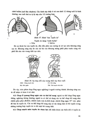 cánh buồm (sai! like shadovv). Các hình này thấyở trẻ em đuôi 12 tháng tuổi là bình
Hình 57. Hình "tim- tuyến ức"
Tuyến ức dạng "cánh buồm"
a. Thẳng b. Nghiêng
Do sụ thoái lui của tuyến úc, dần dằn phía sau xương úc sẽ tạo nên khoảng sáng
sau úc. Khoảng sáng này do các túi bịt của khoang màng phổi phía trước cùng vói
phổi lấn sâu vào trung thất tạo nên.
Hình 58. Sụ thay đồi cùa trung thất tùy theo tuổi
ĐMC: Dộng mạch chú CS: CỘI sòng
KQ: Khí quản TM: Tĩnh mạch chù trên
Do vậy, trên phim chụp lồng ngục nghiêng ỏ nguôi truồng thành, khoảng sáng sau
úc de nhận rõ hon ỏ trẻ nhỏ.
4.2. Chụp X quang lồng ngực các tư thế bổ sung: ngoài tu thế chụp lồng ngục
thẳng, nghiêng thông thường, nguôi ta có thế sú dụng các tu thế chụp bố sung nhu
chếch phía phải (RAO), chếch truốc trái (LAO) hoặc chếch lồng ngục 55° trái- phải
dề bộc lộ tuyến úc. Các tu thế chụp bổ sung này có tác dụng làm rõ bò luyến trong
những truòng họp tuyến ức to dã vượt bò trung thất.
4.3. Chụp mạch máu tuyến ức chọn lọc: để chẩn đoán các biến dối ò tuyến ức
61
 
