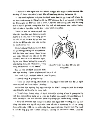 + Bệnh nhân nằm ngứa trên bàn, uỡn cố và ngục. Đàu duọc hạ thấp hon mãi bàn
khoảng 10°, hoặc bằng cách kê một đệm gói sau lung sát vùng hai xuong bả.
+ Thầy thuốc ngồi bên trái phía dầu bệnh nhân. Sau khi gây tê tại chỗ ò hõm úc,
sát bò trên các xương ức. Dùng kim bẻ gập 130° chọc qua da, rà sát kim mặt sau xương
ức. Hướng góc mó 130° của kim ra truóc. Chọc sâu kim khoáng 3cm. Trọ thú dùng
kìm cố định ó góc kim. Dùng bom tiêm thủy tinh hút thù xem có máu ra theo không.
Nếu có máu ra theo kim cần lùi kim và thay đối hướng chọc.
Trước khi bom khí vào trung thất càn
tiêm vào theo kim một lượng novocain
0,25% tù 1-2 mi, vừa có tác dụng gây tê
tại chỗ, vừa dề thù xem áp lục bom vào
có nhẹ tay không, nếu cảm giác nhẹ tay
thì mói bom khí vào.
Có thề sú dụng CƠ2 hoặc khí tròi dược
lọc qua 5 lóp gạc nhúng cồn để tiệt khuẩn.
Mỗi làn bom vào khoảng 50cm3
trong
một phút. Khi rút bom tiêm dể lấy khí
cần khóa đàu kim tránh khí xì ra ngoài.
Áp lục bơm 50 em3
không khí trong một
phút tuông duong 30-50 em nước. Tống
lượng khí bom vào tù 200-500cm3
.
Sau khi bom khí bệnh nhân cần dược
nằm nghi khoảng 15 phút tại giuòng mói được di lại.
Sau Ì đến 2 giò cho bệnh nhân di chụp X quang.
- Kỹ thuật chụp X quang cắt lóp:
+ Trước khi chụp cắt lóp, chiếu kiềm tra lồng ngục dề xác định múc độ khí ngấm
vào trung thất và khu trú vị trí càn chụp.
Chiếu bình diện nghiêng lồng ngục vói diện thế 80KV; cuông độ 2mA đủ đế nhận
biết thòi điềm khí lan tỏa vào trung thất.
+ Tu thế chụp: thường chụp cắt lóp ó bình diện nghiêng. Chụp X quang cắt lóp
bình diện thẳng chi áp dụng khi u tuyến ức đã phát Iriến vuọt bò trung thất hoặc ít
nhiều dã thấy rõ trên bình diện của phim chụp lồng ngục chuẩn thông thường.
+ Chup cắt lóp bình diên thẳng: bênh nhàn nằm ngửa trên bàn chụp, hai tay xuôi
thẳng theo mình. Các lóp cất dược điều chinh bắt đàu tù sau xương úc 3-5 em (tuông
đương chiều sâu 10-12 em cùa chiều dày lồng ngục truóc sau ỏ nguôi lòn). Tia chính
di vào chỗ tiếp giáp cán và thân xuong úc. Các lóp cắt cách nhau lOmm. Điện thế
Hình 59. Vị trí chọc kim dế bom khí
trung thất
64
 