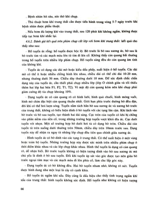 . Bệnh nhân hít sâu, nín thò khi chụp.
. Thủ thuật bom khí trung thất càn được tiến hành trong vòng 5-7 ngày truóc khi
bệnh nhân được phẫu thuật.
. Nếu bom đủ luông khí vào trung thất, sau 120 phút khí không ngấm, không được
tiếp tục bom khí nhắc lại.
4.6.2. Dành giá kết quà trên phim chụp cắt lóp với bơm khí trung thát: kết quả cho
thấy nhu sau:
- Hố tuyến ức rỗng: hố tuyến đuọc bộc lộ. Bò trước là bò sau xương úc, bò sau là
bò truóc tim và các mạch máu lớn tù tim đi lên cổ. Không thấy cản quang bất thuồng
trong hố tuyến trên nhiều lóp phim chụp. Hố tuyến sáng đều do cản quang âm tính
của không khí.
- Tuyến ức có dạng các dải mò hoặc kiểu dấu phẩy, xuất hiện ỏ hố tuyến. Các dái
mò có thề ít hoặc nhiều chồng hình lên nhau, chiêu dài có thể chi dài 10-20 mm,
nhung thường đuôi 50 mm. Chiều dày thuòng đuôi lo mm. Để xác định chắc chắn
dạng này của tuyến ức, cần thiết phải chụp nhiều lóp (lóp o chính giũa và tối thiểu
thêm hai lốp hai bên Fl, F2, TI, T2). Vì mật độ cản quang kém nên khi chụp phải
giảm cuông độ tia chụp khoảng 10%.
- Dạng tuyến ức có cản quang rõ có hình lưỡi, hình quả chuối, hình móng vuốt,
hình mỏ chim đặc biệt cản quang thuần nhất. Giói hạn phía trước đường bò dầu dặn,
dôi khi có thề hoi lượn sóng. Tuyến nằm tách hẳn bò sau xương ức và xương bò trước
của trung thất, không có biếu hiện dính ỏ bò tuyến vói các tạng lân cận. Khí lách vào
bò trước và bò sau tuyến, tạo thành hai dái sáng. Cục trên cùa tuyến có khi bị chông
vào phần mềm cùa nền cố, trong nhũng trường họp tuyến vượt khỏi dĩa ức. Cục đuôi
tuyến vót nhọn. Một số trường họp bò dưới hoi tù có dạng bò tròn. Chiêu dài của
tuyến tù trên xuống dưới thường trên 50mm, chiêu dày trên lOmm trước sau. Dạng
tuyến này dễ nhận ra ngay tù nhũng lóp chụp đầu tiên qua chính giũa xuong ức.
- Hình tuyến úc có bò dính vào các tạng ó trung thất. Có thề xuất hiện ò một vùng
hoặc toàn bộ tuyến. Nhũng trường họp này được xác minh trên nhiều phim chụp ỏ
thòi điềm khác nhau và các lóp chụp khác nhau. Hình thể tuyến là dạng có cản quang
rõ, dễ nhận biết. Bò trước tuyến không có hiện tuông dính vào bò sau xuong ức mà
chù yếu là dính ỏ bò sau tuyến. Đói khi tuyến áp sát vào góc được tạo nên giũa bò
trước ngoại tâm mạc và các mạch máu di lên phía cố, làm che lấp góc này.
- Dạng tuyến úc có bò không đều. Hai bò luyến nham nhỏ, không rõ nét. Tuyến
duọc hình dung nhu một loại lá cây có cạnh khía.
- Hố tuyến ức ngấm khí xấu. Đây cũng là dấu hiệu cho thấy tình trạng ngấm khí
xấu cùa trung thất: hình tuyến không xác định. Hò tuyến nhu không có hiện tượng
66
 