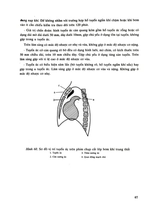 đung nạp khí. Đế không nhâm vối truồng họp hố tuyến ngấm khí chậm hoặc khí bom
vào ít cần chiếu kiềm tra theo dõi trên 120 phút.
• Giá trị chần đoán: hình tuyến ức cản quang kém gồm hố tuyến ức rỗng hoặc có
dạng dải mò dài đuôi 50 mm, dày đuối lOmm, gặp chủ yếu ỏ dạng tồn tại tuyến, không
gặp trong u tuyến ức.
Trên lâm sàng có mức độ nhược co nhẹ và vừa, không gặp ó mức độ nhược co nặng.
- Tuyến ức cớ cản quang rõ bò đều có dạng hình lưỡi, mỏ chim, có kích thuốc trên
50 mm chiều dài, trên 10 mm chiều dày. Gặp chù yếu ỏ dạng tăng sàn tuyến. Trên
lâm sàng gặp vói ti lệ cao ỏ múc độ nhược ca vừa.
- Tuyến ức có biểu hiện xâm lấn (bò tuyến không rõ, hố tuyến ngấm khí xấu) hay
gặp trong u tuyến ức. Lâm sàng gặp ỏ mức độ nhược co vừa và năng. Không gặp ỏ
múc độ nhược co nhẹ.
à- 4
Hình 60. So đồ vị trí tuyến ứẹ trên phim chụp cắt lóp bom khí trung thất
1. Tuyến ức 3. Thân xương ủc
2. Cán xướng úc 4. Quai động mạch chủ
67
 