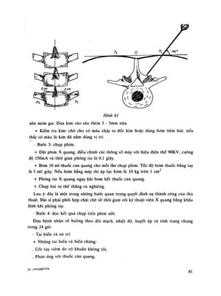 Hình 61
nền mỏm gai. Đua kim vào sâu thêm 3 - 5mm nữa.
+ Kiểm tra kim: chò cho có máu chảy ra đốc kim hoặc dùng bom tiêm hút, nếu
thấy có máu là kim đã nằm đúng vị trí.
- Bước 3: chụp phim.
+ Đặt phim X quang, điều chinh các thông số máy vối hiệu điện thế 90KV, cuông
độ 150mA và thòi gian phóng tia là 0,1 giây.
+ Bơm 10 mi thuốc cản quang cho mỗi lần chụp phim. Tốc độ bom thuốc bằng tay
là 3 mi/ giây. Nếu bom bằng máy thì áp lực bom là 10 kg trên Ì em2
+ Phóng tia X quang ngay khi bom hết thuốc cản quang.
+ Chụp hai tu thế thẳng và nghiêng.
Lưu ý: dây là một trong những bước quan trọng quyết định sự thành công cùa thủ
thuật. Bác sĩ phải phối họp chặt chẽ về thòi gian vói kỹ thuật viên X quang bằng khẩu
lệnh khi phóng tia.
- Buỏc 4: đọc kết quả chụp trên phim ướt.
Đua bệnh nhân về buồng theo dõi mạch, nhiệt độ, huyết áp và tình trạng chung
trong 24 giò.
- Tai biến và xử trí:
+ Nhũng tai biến và biến chứng:
. Cốt tủy viêm do vô khuẩn không tốt.
. Phản úng vói thuốc cản quang.
T6 • CPPCĐBTVTK 81
 
