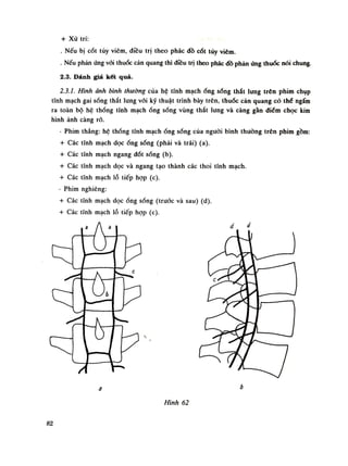 + Xú trí:
. Nếu bị cót tủy viêm, điều trị theo phác đồ cốt tủy viêm.
. Nếu phản úng vói thuốc cản quang thì điêu trị theo phác đồ phản úng thuốc nói chung.
2.3. Đánh giá kết quà.
2.3.1. Hình ảnh bình thường của hệ tĩnh mạchống sóng thắt lung trên phim chụp
tĩnh mạch gai sống thắt lung vãi kỹ thuật trình bày trên, thuốc cản quang có thè ngấm
ra toàn bộ hệ thống tĩnh mạchống sống vùng thắt lung và càng gần diêm chọc kim
hình ảnh càng rõ.
- Phim thẳng: hệ thống tính mạchống sống của nguôi bình thuồng trên phim gồm:
+ Các tĩnh mạch dọcống sống (phải và trái) (a).
+ Các tĩnh mạch ngang đốt sống (b).
+ Các tĩnh mạch dọc và ngang tạo thành các thoi tĩnh mạch.
+ Các tĩnh mạch lỗ tiếp họp (c).
- Phim nghiêng:
+ Các tĩnh mạch dọcống sống (trước và sau) (d).
+ Các tĩnh mạch lỗ tiếp họp (c).
Hình 62
82
 