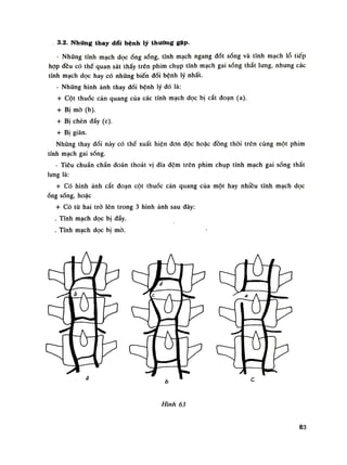 3.2. Những thay dổi bệnh lý thường gặp.
- Nhũng tĩnh mạch dọc óng sống, tĩnh mạch ngang đốt sống và tĩnh mạch lỗ tiếp
họp đều có thế quan sát thấy trên phim chụp tĩnh mạch gai sóng thắt lưng, nhưng các
tĩnh mạch dọc hay có nhũng biến đổi bệnh lý nhất.
• Những hình ảnh thay đổi bệnh lý đó là:
+ Cột thuốc cản quang cùa các tính mạch dọc bị cắt đoạn (a).
+ Bị mò (b).
+ BỊ chèn dẩy (c).
+ Bị giãn.
Những thay đổi này có thề xuất hiện đon độc hoặc đồng thòi trên cùng một phim
tính mạch gai sống.
- Tiêu chuẩn chẩn đoán thoát vị đĩa đệm trên phim chụp tĩnh mạch gai sống thắt
lung là:
+ Có hình ảnh cắt đoạn cột thuốc cản quang cùa một hay nhiều tĩnh mạch dọc
ống sống, hoặc
+ Có từ hai trở lên trong 3 hình ảnh sau đây:
. Tĩnh mạch dọc bị đẩy.
. Tĩnh mạch dọc bị mò.
Hình 63
63
 