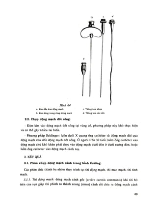 Hình 64
a. Kim dẫn kim động mạch c. Thõng kim nhọn
b. Kìm dùng trong chụp dộng mạch d. Thông kim cài tiến
2.2. Chụp dộng mạch dốt sống:
- Đâm kim vào dộng mạch đốt sống tại vùng cổ, phương pháp này khó thục hiện
và có thể gây 'nhiều tai biến.
• Phương pháp Seldinger: luồn đuôi X quangống cathéter tù động mạch dùi qua
động mạch chủ đến dộng mạch đốt sống. nguôi trên 30 tuổi, luồnống cathéter vào
động mạch chù khó khăn phải chọc vào dộng mạch đuôi đòn ó đuôi xuong đòn, hoặc
luồnống cathéter vào động mạch cánh tay.
3. KẾT QUẢ
3.1. Phim chụp dộng mạch cảnh trong bỉnh thưởng.
Các phim chia thành ba nhóm theo trình tụ: thì động mạch, thì mao mạch, thì tĩnh
mạch.
3.1.1. Thì động mạch: động mạch cảnh gốc (artère carotis communis) khi tói bò
trên cùa sụn giáp thì phình to thành xoang (sinus) cảnh rồi chia ra động mạch cảnh
89
 