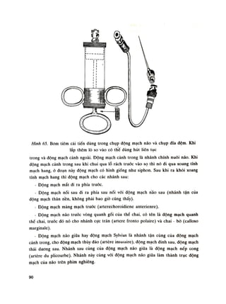 Hình 65. Bom tiêm cải tiến dùng trong chụp động mạch não và chụp đĩa đệm. Khi
lắp thêm lò so vào có thể dùng hút liên tục
trong và động mạch cảnh ngoài. Động mạch cảnh trong là nhánh chính nuôi não. Khi
động mạch cảnh trong sau khi chui qua lỗ rách truóc vào sọ thì nó đi qua xoang tĩnh
mạch hang, ó đoạn này động mạch có hình giống nhu siphon. Sau khi ra khỏi xoang
tĩnh mạch hang thì động mạch cho các nhánh sau:
- Động mạch mắt di ra phía truóc.
- Động mạch nối sau đi ra phía sau nối vói động mạch não sau (nhánh tận của
động mạch thân nền, không phải bao giò cũng thấy).
- Động mạch màng mạch trước (arterechoroidiene anterienre).
• Động mạch não trước vòng quanh gối cùa thể chai, có tên là động mạch quanh
thè chai, trước đó nó cho nhánh cục trán (artere fronto polaire) và chai - bò (calloso
marginale).
- Động mạch não giữa hay động mạch Sylvius là nhánh tận cùng của động mạch
cảnh trong, cho động mạch thúy đảo (artère insuiaire), động mạch đinh sau, dộng mạch
thái dương sau. Nhánh sau cùng của động mạch não giũa là động mạch nếp cong
(artère du plicourbe). Nhánh này cùng vói động mạch náo giũa làm thành trục dộng
mạch cùa não trên phim nghiêng.
90
 