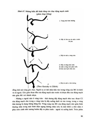 Hình 67. Nhũng biến đối hình dáng cùa chạc động mạch cảnh
(phim chụp thẳng)
a. Trạng thái binh thường.
b. Dẩy AI lên cao do một u trước
hổ yfin.
c. Dẩy do một u vùng trán.
d. Dẩy có dáng hĩnh nám
do một u vùng trán phát triển
tói khu vực hạch thân não.
e. Dây do một u thái dưỡng,
(Theo Kautzkỵ và Zulch).
đồng thòi mò rộng góc chạc. Nguôi ta có thể nhìn hẳn vào trong vòng cùa MI tù đuôi
và từ ngoài. Góc giũa đoạn đầu của động mạch não trước và đoạn đàu của động mạch
não giũa MI trò thành nhọn.
- Những u ngoài não ỏ vùng trán - thái duong đẩy dộng mạch nhu sau: đoạn C2
của dộng mạch chủ trong u vùng trán bị dầy xuống đuối và vào trong, trong u vùng
thái duong bị dựng thẳng đứng lên. Vòng cung cùa MI cùa động mạch não giũa bình
thuồng nằm trong một bình diện ngang dường chân tròi, bị một khối u nhò nằm ỏ
phía trên cánh nhó xương buóm đấy ra phía trước - ngoài và xuống đuôi. Trên phim
95
 