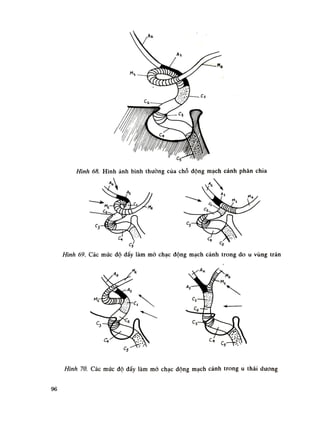 Hình 68. Hình ảnh bình thường của chỗ dộng mạch cảnh phân chia
Hình 69. Các mức độ đầy làm mò chạc động mạch cảnh trong do u vùng trán
Hình 70. Các mức độ đầy làm mỏ chạc động mạch cảnh trong u thái duong
 