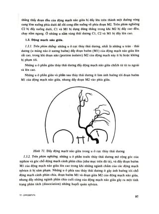 thẳng thấy đoạn đầu của động mạch não giũa bị dấy lên trên thành một đường vòng
cung lõm xuống phía duỗi để rồi cong dần xuống về phía đoạn M2. Trên phim nghiêng
C2 bị đấy xuống dưới, Cl và MI bị dụng đứng thẳng trong khi M2 bị đẩy cao đều,
chạy nằm ngang.Ỏ nhũng u nằm vùng thái dương Cl, C2 và MI bị đấy lên cao.
1.3. Dộng mạch náo giữa.
1.3.1. Trên phim thằng: những u ỏ cục thúy thái duong, nhất là những u trán - thái
dương (u màng não ò xương buóm) đấy đoạn bướm (MI) của động mạch não giũa lên
rất cao, trong khi đoạn não (portion isulaire) M2 cùa động mạch này ít bị hoặc không
bị phạm tói.
Nhũng u ó phần giũa thúy thái dương đẩy động mạch não giũa chếch tù tù ra ngoài
và lên cao.
Những u ỏ phần giũa và phần sau thúy thái dương ít làm ảnh huống tói đoạn bướm
MI của động mạch não giữa, nhung đẩy đoạn M2 vào phía giữa.
Hình 71. Đẩy động mạch' não giữa trong u ỏ cục thúy thái duong
1.3.2. Trên phim nghiêng, nhũng u ỏ phần truóc thúy thái dương mò rộng góc cùa
syphon và góc chỗ dộng mạch cảnh phân chia (nhu mục trên đã tả), và đầy đoạn bướm
MI của dộng mạch não giũa lên cao trong khi nhũng ngành chầm của các động mạch
sylvien ít bị xâm phạm. Nhũng u ỏ phía sau thúy thái dương ít gây ảnh hướng tói chỗ
động mạch cành phân chia, đoạn buóm MI và đoạn giữa M2 cùa động mạch não giũa,
nhung đầy nhũng ngành phân chia cuối cùng cùa động mạch não giũa gây ra một tình
trạng phân tách (dissociation) những huyết quản sylvien.
T7 - CPPCOBTVTK 97
 
