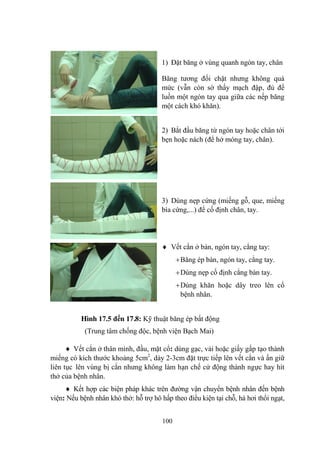 100
1) Đặt băng ở vùng quanh ngón tay, chân
Băng tƣơng đối chặt nhƣng không quá
mức (vẫn còn sờ thấy mạch đập, đủ để
luồn một ngón tay qua giữa các nếp băng
một cách khó khăn).
2) Bắt đầu băng từ ngón tay hoặc chân tới
bẹn hoặc nách (để hở móng tay, chân).
3) Dùng nẹp cứng (miếng gỗ, que, miếng
bìa cứng,...) để cố định chân, tay.
Vết cắn ở bàn, ngón tay, cẳng tay:
Băng ép bàn, ngón tay, cẳng tay.
Dùng nẹp cố định cẳng bàn tay.
Dùng khăn hoặc dây treo lên cổ
bệnh nhân.
Hình 17.5 đến 17.8: Kỹ thuật băng ép bất động
(Trung tâm chống độc, bệnh viện Bạch Mai)
Vết cắn ở thân mình, đầu, mặt cổ: dùng gạc, vải hoặc giấy gấp tạo thành
miếng có kích thƣớc khoảng 5cm2
, dày 2-3cm đặt trực tiếp lên vết cắn và ấn giữ
liên tục lên vùng bị cắn nhƣng không làm hạn chế cử động thành ngực hay hít
thở của bệnh nhân.
Kết hợp các biện pháp khác trên đƣờng vận chuyển bệnh nhân đến bệnh
viện: Nếu bệnh nhân khó thở: hỗ trợ hô hấp theo điều kiện tại chỗ, hà hơi thổi ngạt,
 