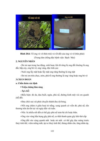 122
TTææ ong vong vßß vvÏÏ OngOng vvßß vvÏÏ ®®èètt .
Hình 20.6: Tổ ong vò vẽ (bên trái) và vết đốt của ong vò vẽ (bên phải)
(Trung tâm chống độc bệnh viện Bạch Mai)
2. NGUYÊN NHÂN
- Do tai nạn trong lao động, sinh hoạt, khi đi rừng bị ong đốt thƣờng là ong
đất, bắp cày, ong bò vẽ, ong vàng, độc tính cao
- Nuôi ong lấy mật hoặc lấy mật ong rừng thƣờng là ong mật
- Do trẻ em trêu chọc, ném, phá tổ ong thƣờng là ong vàng hoặc ong bò vẽ
3.CHẨN ĐOÁN
a. Chẩn đoán xác định
Triệu chứng lâm sàng
- Tại chỗ:
Biểu hiện: đỏ da, đau buốt, ngứa, phù nề, đƣờng kính một vài cm quanh
chỗ đốt.
Đau chói sau vài phút chuyển thành đau rát bỏng.
Nốt ong châm ở giữa hoại tử trắng, xung quanh có viền đỏ, phù nề, tổn
thƣơng trên da tồn tại vài ngày đến vài tuần.
Nếu bị nhiều nốt đốt có thể gây phù nề toàn bộ chi hoặc thân.
Ong vào vùng hầu họng gây phù nề, co thắt thanh quản gây khó thở cấp
Ong đốt vào vùng quanh mắt hoặc mi mắt có thể gây đục màng trƣớc
thuỷ tinh thể, viêm mống mắt, áp xe thuỷ tinh thể, thủng nhãn cầu, tăng nhãn áp,
 