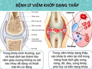 BỆNH LÝ VIÊM KHỚP DẠNG THẤP
Trong khớp bình thường, sụn
và hoạt dịch tạo thành lớp
nệm giúp xương không cọ sát
vào nhau dễ dàng và thoải
mái khi cử động
Trong viêm khớp dạng thấp,
các khớp bị viêm tại chỗ trong
màng hoạt dịch gây sưng,
nóng, đỏ, đau, cứng khớp,
phá hủy và biến dạng khớp
 
