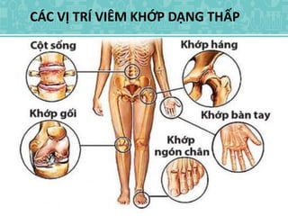 CÁC VỊ TRÍ VIÊM KHỚP DẠNG THẤP
 