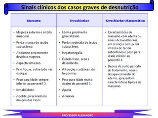 Sinais clínicos dos casos graves de desnutrição
PROFESSOR ALEXANDRE
 