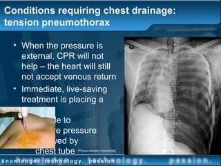 Conditions requiring chest drainage:
tension pneumothorax
• When the pressure is
external, CPR will not
help – the heart will still
not accept venous return
• Immediate, live-saving
treatment is placing a
needle to
relieve pressure
followed by
chest tube Photos courtesy trauma.org
 