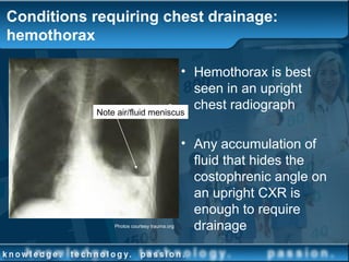 Conditions requiring chest drainage:
hemothorax
• Hemothorax is best
seen in an upright
chest radiograph
• Any accumulation of
fluid that hides the
costophrenic angle on
an upright CXR is
enough to require
drainagePhotos courtesy trauma.org
Note air/fluid meniscus
 