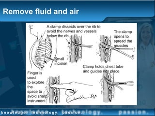 Remove fluid and air
A clamp dissects over the rib to
avoid the nerves and vessels
below the rib
The clamp
opens to
spread the
muscles
Small
incision
Finger is
used
to explore
the
space to
avoid sharp
instrument
Clamp holds chest tube
and guides into place
 