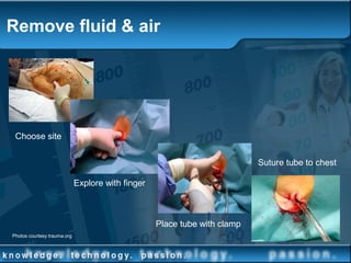 Remove fluid & air
Choose site
Explore with finger
Place tube with clamp
Suture tube to chest
Photos courtesy trauma.org
 