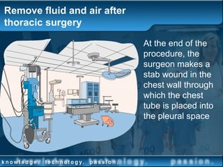 Remove fluid and air after
thoracic surgery
At the end of the
procedure, the
surgeon makes a
stab wound in the
chest wall through
which the chest
tube is placed into
the pleural space
 
