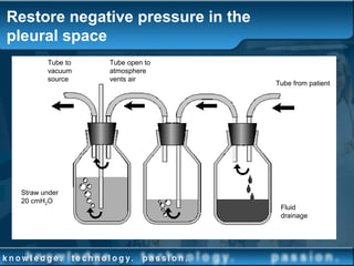 Restore negative pressure in the
pleural space
2cm fluid water seal Collection bottleSuction control
Tube from patient
Fluid
drainage
Tube open to
atmosphere
vents air
Straw under
20 cmH2O
Tube to
vacuum
source
 