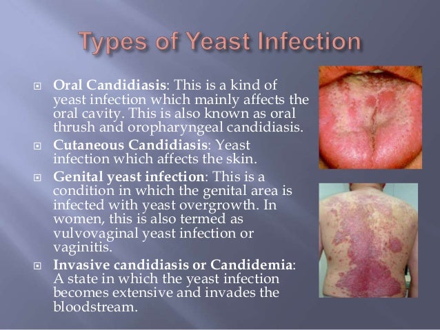 Yeast Infection Probiotic