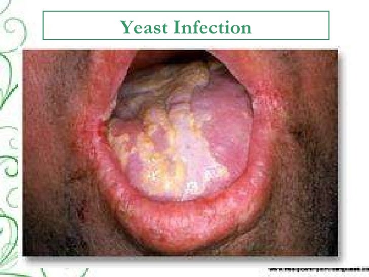 Best and affective Yeast infection treatment