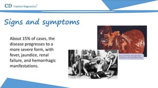 About 15% of cases, the
disease progresses to a
more severe form, with
fever, jaundice, renal
failure, and hemorrhagic
manifestations.
Signs and symptoms
 