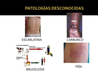 ESCARLATINA    CARBUNCO




                   TIÑA
  BRUCELOSIS
 