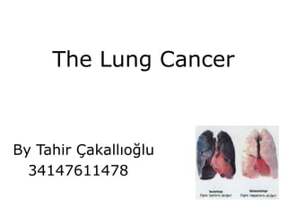TheLungCancer By Tahir Çakallıoğlu      34147611478 