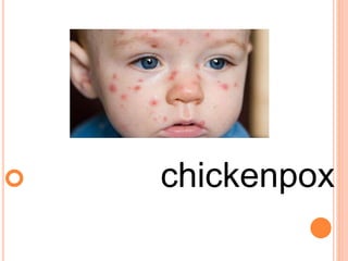  chickenpox
 