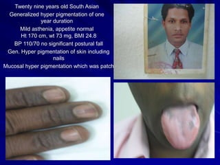 Addison's Disease | PPT