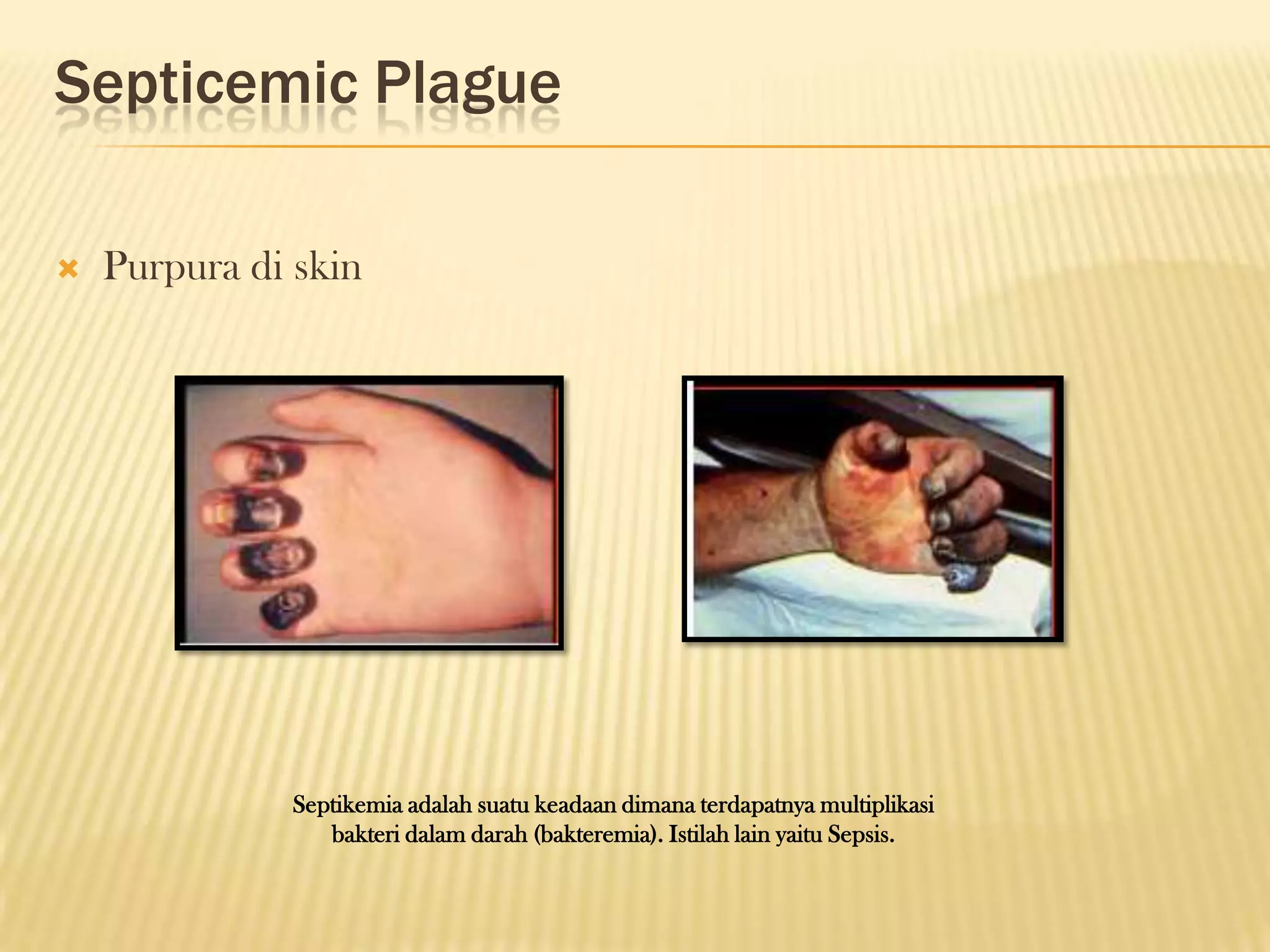 Septicemic Plague

   Purpura di skin




              Septikemia adalah suatu keadaan dimana terdapatnya multiplikasi
                 bakteri dalam darah (bakteremia). Istilah lain yaitu Sepsis.
 