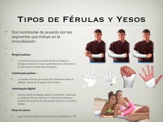 Tipos de Férulas y Yesos
•   Son nombradas de acuerdo con los
    segmentos que incluye en la
    inmovilización
•   :

•   Braquio-palmar-

    •    va desde el tercio proximal del brazo hasta el
         pliegue distal de la mano permitiendo la flexión de
         la articulación metacarpofalángica, 

•   Ántebraquio-palmar –

    •    va desde el tercio proximal del antebrazo hasta el
         pliegue distal de la palma de la mano. 

•   Antebraquio-digital-

    •    incluye hasta la falange distal, Escafoidéa- utilizada
         en lesiones de este hueso y va desde el antebrazo
         hasta la base de la uña del primer dedo por el borde
         radial. 

•   Pinza de azúcar-

    •    para la inmovilización de fracturas de húmero y Ab
 