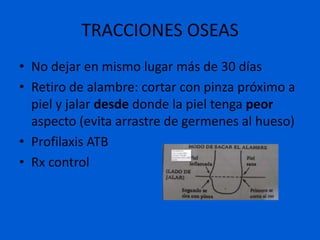 TRACCIONES OSEAS
• No dejar en mismo lugar más de 30 días
• Retiro de alambre: cortar con pinza próximo a
  piel y jalar desde donde la piel tenga peor
  aspecto (evita arrastre de germenes al hueso)
• Profilaxis ATB
• Rx control
 