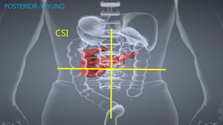 CSI
POSTERIOR-YEYUNO
 