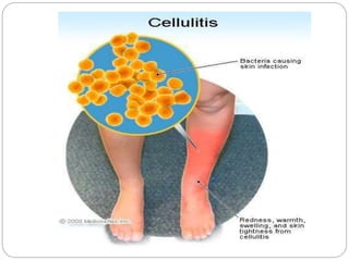 cellulitis | PPTX