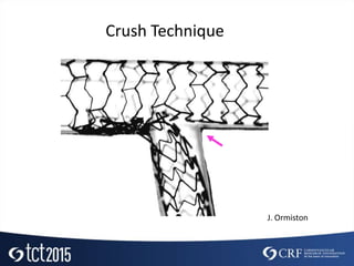 Crush Technique
J. Ormiston
 