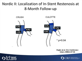 Nordic II: Localization of In-Stent Restenosis at
8-Month Follow-up
 