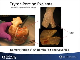 Tryton Porcine Explants
Demonstrate Complete Corinal Coverage
Tryton
Demonstration of Anatomical Fit and Coverage
 