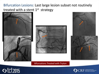 Bifurcation Lesions: Last large lesion subset not routinely
treated with a stent 1st strategy
Bifurcations Treated with Tryton
 