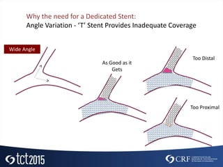 Wide Angle
As Good as it
Gets
Too Distal
Too Proximal
Why the need for a Dedicated Stent:
Angle Variation - ‘T’ Stent Provides Inadequate Coverage
 