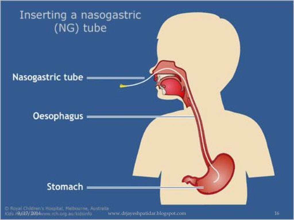 Nasogastric feeding or gavage feeding